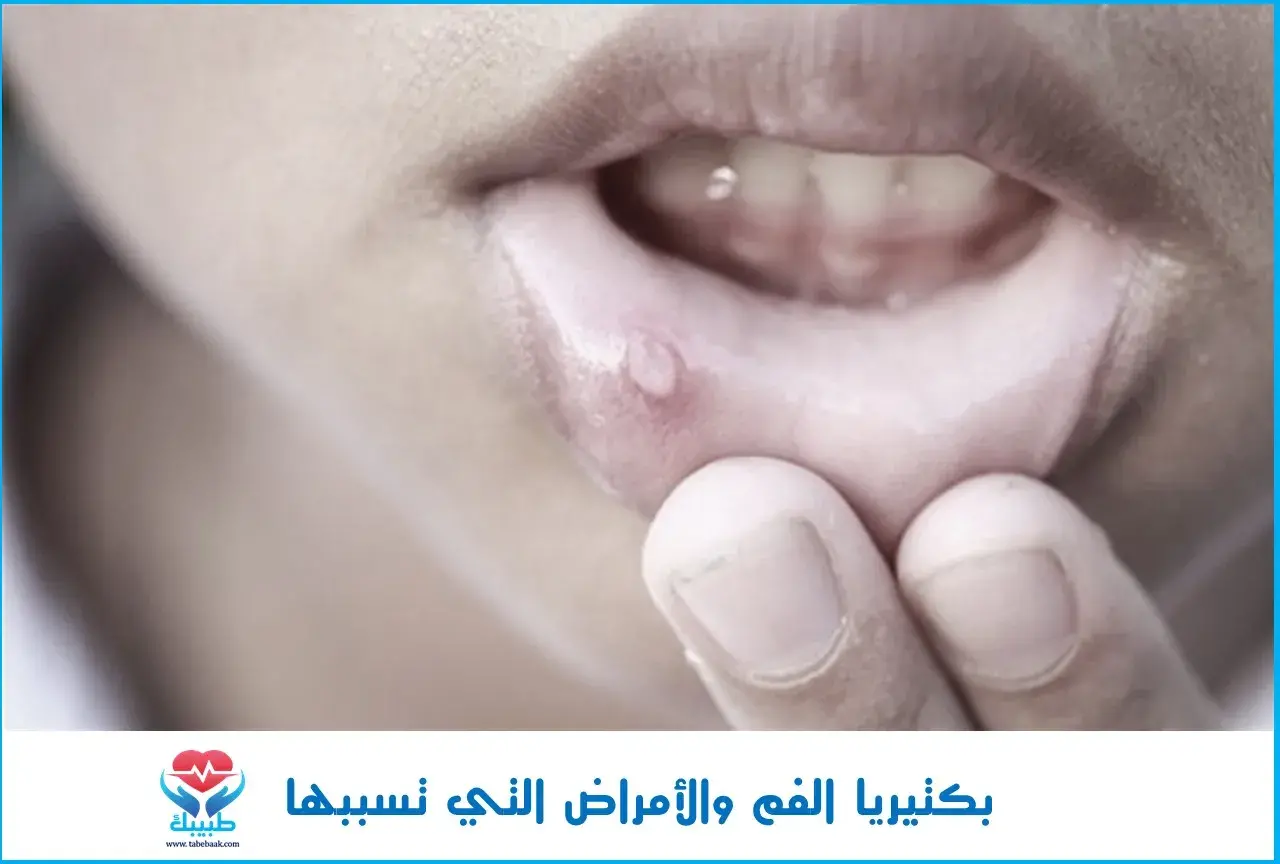 بكتيريا الفم والأمراض التي تسببها