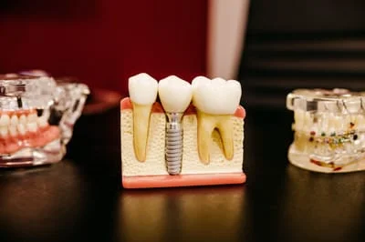 تسوس الأسنان أسبابه وعلاجه لدى الأطفال والبالغين