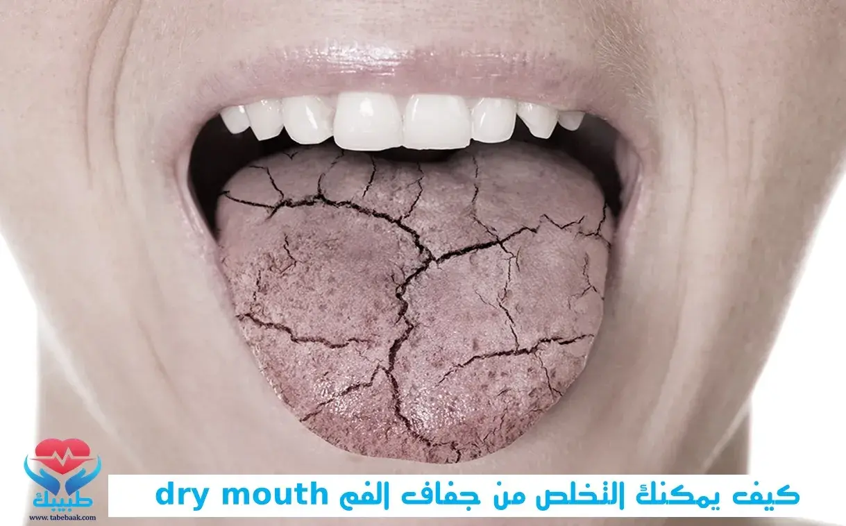 كيف يمكنك التخلص من جفاف الفم dry mouth